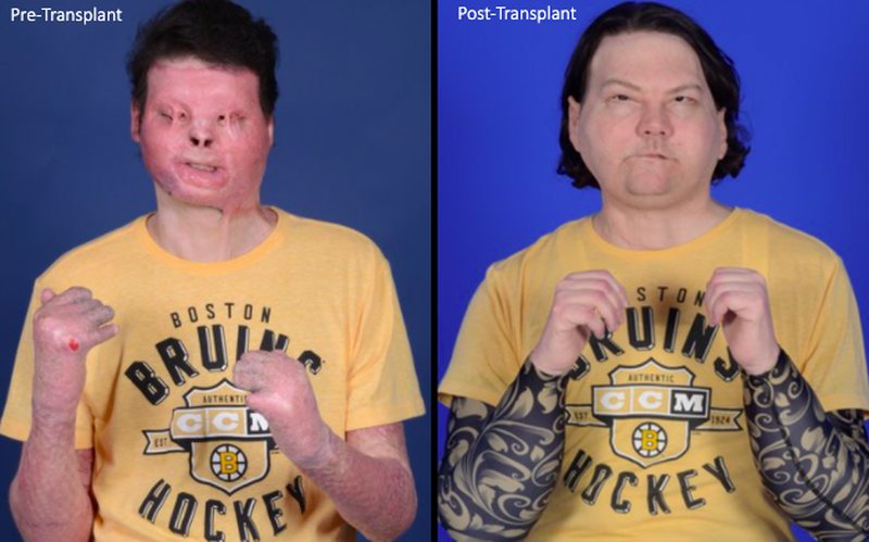 DiMeo före och efter transplantationen. Bildkälla: AP DiMeo före och efter transplantationen. Bildkälla: AP